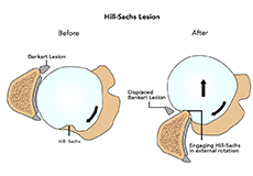 Hill-Sachs Lesion