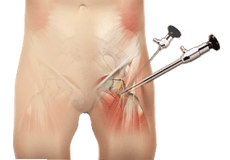 Hip Arthroscopy - Supine Position
