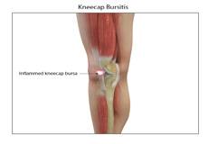 Kneecap Bursitis