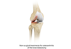Non-Surgical Knee Treatments