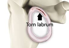 Shoulder Labral Tear with Instability